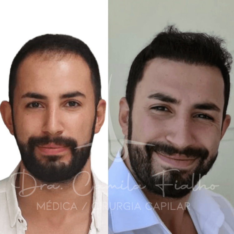 Antes e depois 02