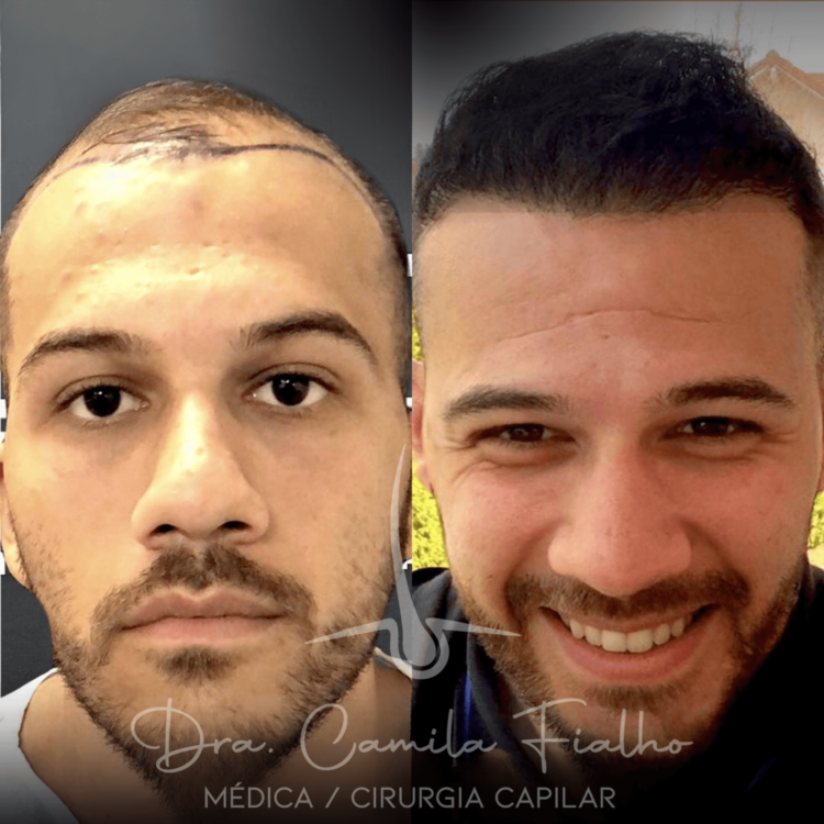 Antes e depois 04